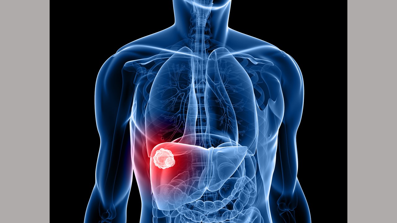 Novel AI Blood Test Detects Liver Cancer TrendRadars